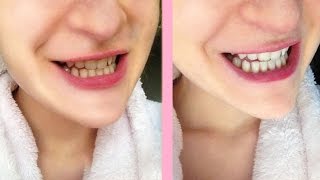 Crest white strips honest review [upl. by Oppen]