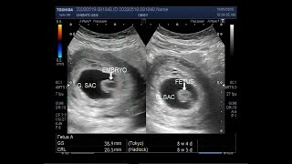 Ultrasound Video showing Early pregnancy with a Missed abortion also called Missed miscarriage [upl. by Toscano190]