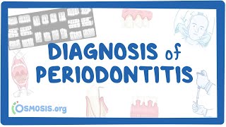 Diagnosis of Periodontitis [upl. by Nibaj]