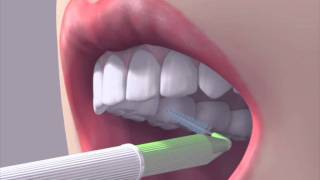 How to use an interdental brush [upl. by Gratianna]