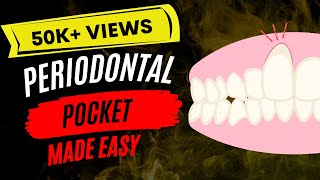 Periodontal disease  Periodontal pocket [upl. by Archaimbaud]