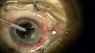 Corneal Replacement Surgery Corneal Transplant or Keratoplasty [upl. by Galina]