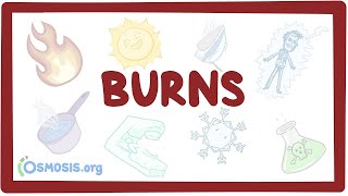 Burns  an Osmosis Preview [upl. by Lanod435]