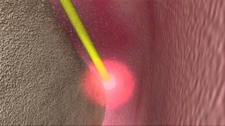 Laser Periodontal Therapy  WPT™ Animation [upl. by Xino]