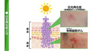 正しく理解しよう「紫外線と皮膚疾患」②日光角化症と有棘細胞がん [upl. by Hocker]