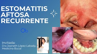 Estomatitis aftosa recurrente 👄 👅 [upl. by Anoyk367]