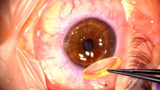 Corneal Transplant Penetrating Keratoplasty for Advanced Keratoconus and Corneal Infiltrates [upl. by Bittner]