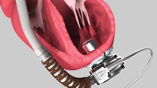 HeartMate II Left Ventricular Assist System  MyLVAD [upl. by Narhet]