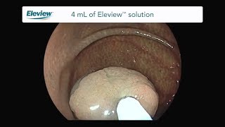 Endoscopic Polypectomy with Eleview™ [upl. by Adam]