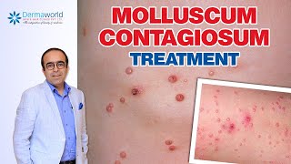 Molluscum Contagiosum Treatment  Dr Rohit Batra [upl. by Geldens597]