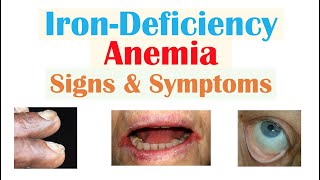 IronDeficiency Anemia Signs amp Symptoms ex Fatigue “Spoon Nails” Cracked Lips [upl. by Figueroa819]