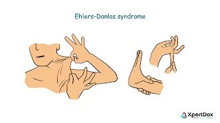 Sjögren’s Syndrome  Signs and Symptoms [upl. by Bishop178]