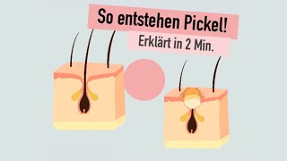 So entstehen Pickel  erklärt in 2 Minuten  WOMANSKILLS [upl. by Maryann853]