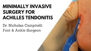 Achilles Tendonitis Treatment with Surgical Debridement Using TenJet Dr Nicholas A Campitelli [upl. by Blakeley]