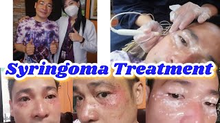 Syringoma Treatment  Home Service [upl. by Friederike]