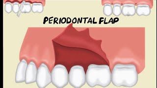 Periodontal Flap [upl. by Ettenad]