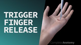 Trigger Finger Release [upl. by Mcguire542]