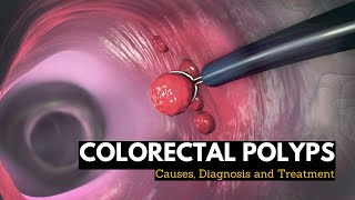 Loop biopsy for suspected endometrial cancer Hysteroscopy [upl. by Aisa]