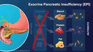 Exocrine Pancreatic Insufficiency [upl. by Isus]