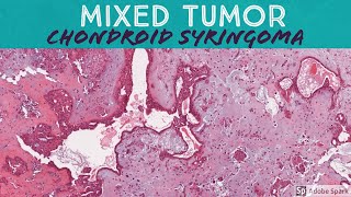 Chondroid Syringoma Mixed Tumor 5Minute Pathology Pearls [upl. by Nitsed]