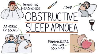 Obstructive Sleep Apnoea [upl. by Ecirtel]