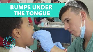 BUMPS UNDER THE TONGUE Symptoms amp Causes [upl. by Pigeon482]