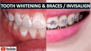 Professional Teeth Whitening With Braces amp Invisalign [upl. by Cerallua612]