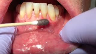 Dr Laurence Rifkin Treatment of Mouth Ulcer [upl. by Adnahsar]