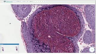 Molluscum Contagiosum  Histopathology [upl. by Barb66]