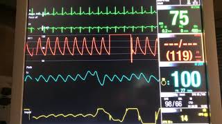 Is this waveform overdamped And how to troubleshoot [upl. by Manthei]