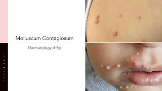 Molluscum Contagiosum [upl. by Iaw270]