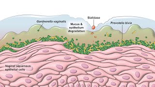 Bacterial Vaginosis  Pathogenesis [upl. by Ordnazil742]