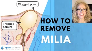 HOW TO REMOVE A MILIA STEP BY STEP  NATURALLY [upl. by Catima582]