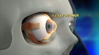 Keratoconus Procedure Explained [upl. by Keene]