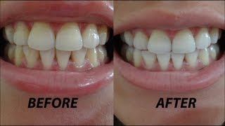 Crest 3D Whitestrips Vivid Before amp After Demo  Review [upl. by Alekin]