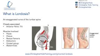 Lordosis Treatment A 3 Step Process [upl. by Sonafets626]