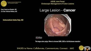 Large Colon Polyp Management in 2020 The Optimal Waye to Approach Endoscopic Removal [upl. by Ozzy]