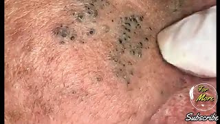 Dr Pop  Deep Blackheads in old Skin removing amp treatment 2020 Part 4 HD [upl. by Tommi757]