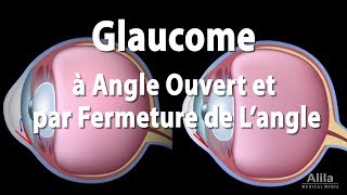 Pathologie du Glaucome Animation [upl. by Donaldson]