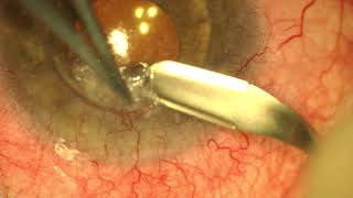 Complex Corneal Transplantation Cataract Surgery Synechialysis [upl. by Lynnea]