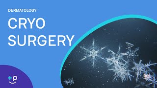 Cryo Surgery Procedure Freezing [upl. by O'Neill287]