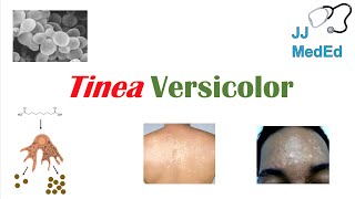 “Fungal Skin Infection of Many Colors” Tinea Versicolor  Pathogenesis Symptoms and Treatment [upl. by Ethyl664]