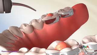 Posterior Bite Block  Orthodontic Treatment [upl. by Andaira]