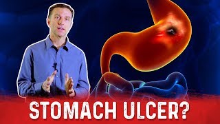 How To Get Rid Of Stomach Ulcer – DrBerg On Peptic Ulcer Treatment [upl. by Eleirbag785]