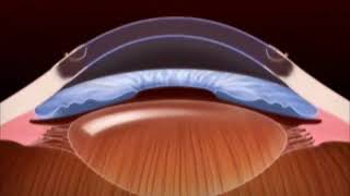 Cornea transplant [upl. by Eanahc]