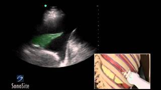 How To Ultrasound Guided Thoracentesis Exam 3D Video [upl. by Hedgcock84]