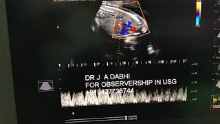 Ductus venosus doppler [upl. by Hunley]