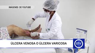 ÚLCERA VENOSA O ÚLCERA VARICOSA [upl. by Yeslrahc]