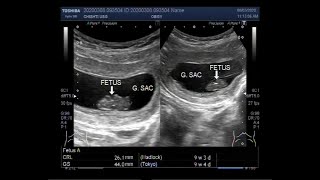 Ultrasound Video showing Missed abortion or Missed miscarriage [upl. by Llehcor]