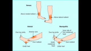 Ulcera cruris  Arterial amp Venous [upl. by Aerdnek734]